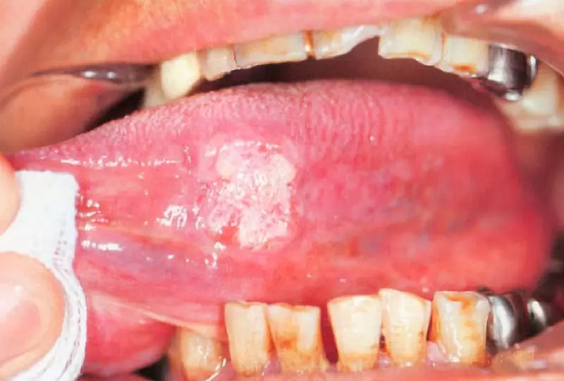 舌癌（口腔癌）の画像