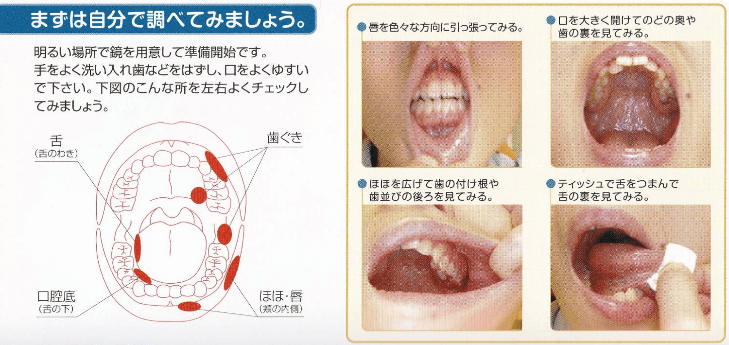 港区赤坂見附の歯医者 赤坂見附歯科 口腔がん